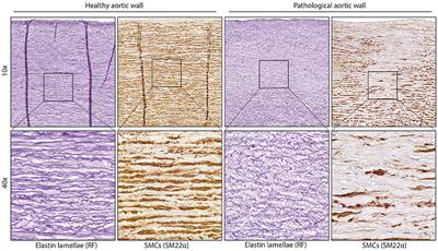 Thoracic Aortic Aneurysm Development in Patients with Bicuspid Aortic Valve: What Is the Role of Endothelial Cells?